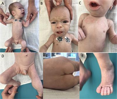 Novel Splicing Variant in the PMM2 Gene in a Patient With PMM2-CDG Syndrome Presenting With Pericardial Effusion: A Case Report